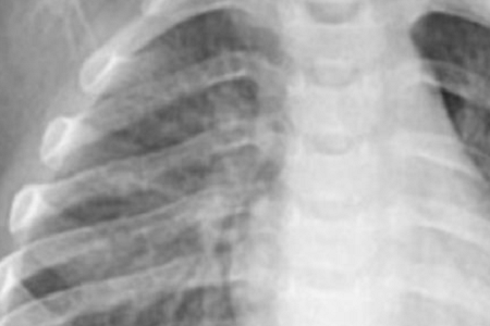 Hurtig påvisning af Chlamydia pneumoniae: pålidelig og effektiv